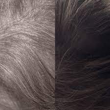 Minoxidil benefits - results - cost - price